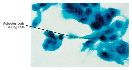 Asbestos particles in lung cells Asbestos particles in lung cells