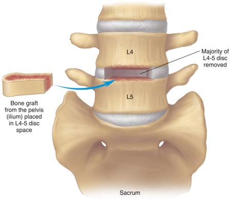 Vertebral fusion Vertebral fusion